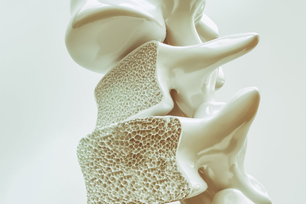 Tipos de osteoporose: Quais são as variações?